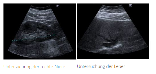Das Bild zeigt eine Ultraschall-Untersuchung der rechten Niere und der Leber