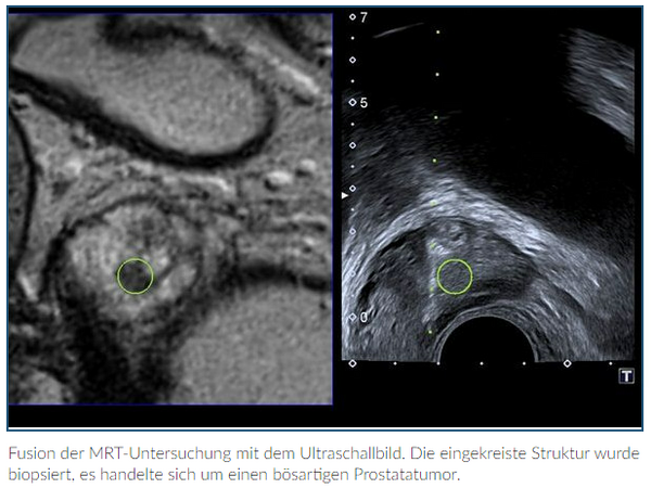 Das Bild zeigt die Fusion der MRT-Untersuchung mit dem Ultraschallbild der Prostata.
