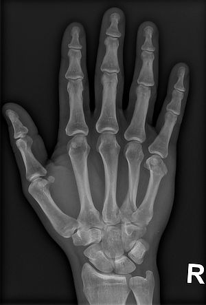 Das Bild zeigt die Röntgenaufnahme einer Hand