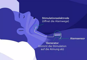 Die Grafik zeigt schematisch, wie der Zungenschrittmacher funktioniert.