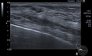 Das Bild zeigt ein Ultraschallbild der Brust