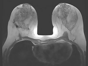 Das Bild zeigt ein MRT-Bild der Brüste