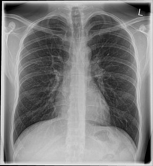 Das Bild zeigt die Röntgenaufnahme eines Thorax